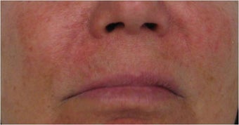 Juvederm to nasolabial folds before 77468