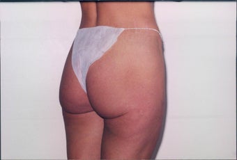 Body Lift before 217907