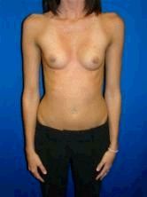 Breast Augmentation before 353463