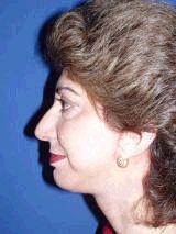 Chin Implants after 357646