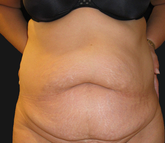 Abdominoplasty before 458935