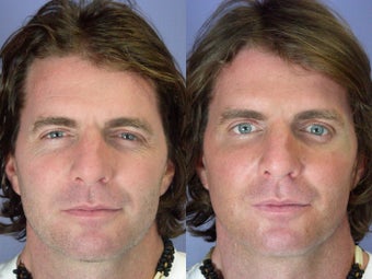 Botox before 302138