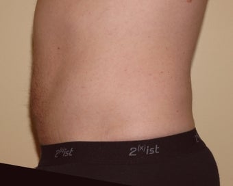 Male Liposuction - Abdomen after 240158
