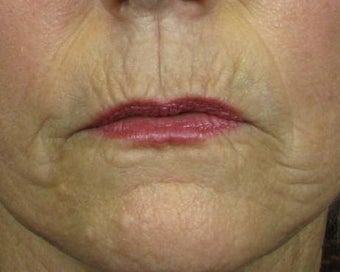 Ridding Lip Lines & Wrinkles with C02 Laser before 628481