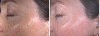 IPL for hyperpigmentation and freckles on face before 6604
