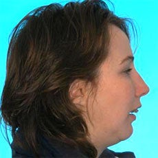 Orthognathic Jaw Surgery before 510584