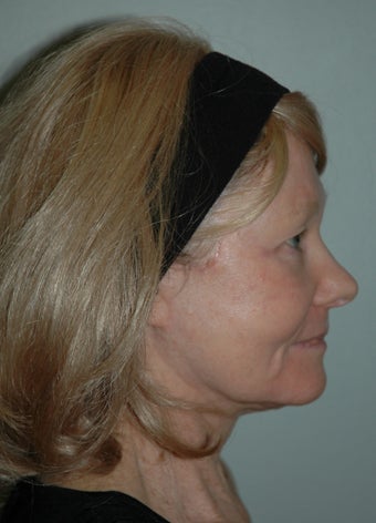 High SMAS Face Lift, Neck Lift, Perioral Dermabrasion 468008