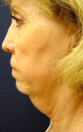 Neck liposculpture before 374887
