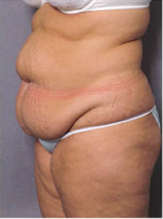 Adominoplasty 428195
