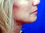 Neck Lift after 87074