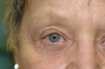 Bilateral upper and lower eyelid surgery 341554