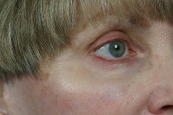 Botox 309232