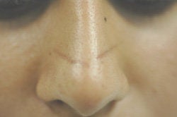 Scar Removal before 145655