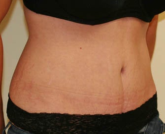 Abdominoplasty (Tummy Tuck) and Breast Augmentation after 216688