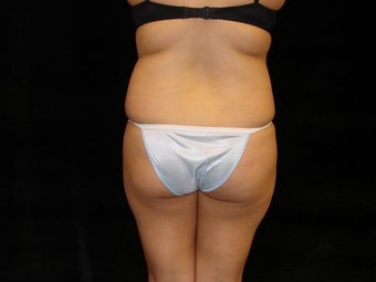 Brazilian Butt Lift before 227322