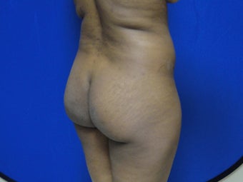 Brazilian Butt Lift/Fat Grafting Buttock Augmentation before 599823