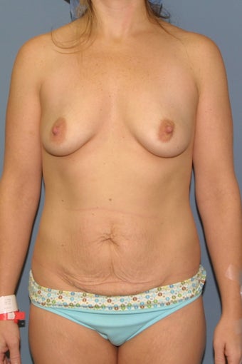 Mommy Makeover Breast augmentation and tummy tuck before 539084