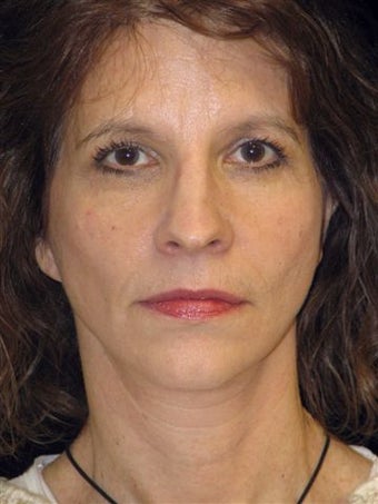 Face lift,brow lift, eyelid lift after 250983