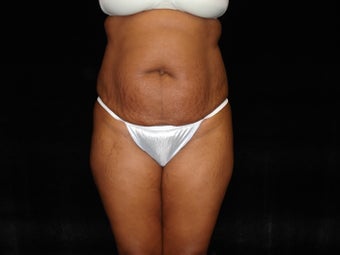 Standard Abdominoplasty before 203398