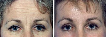 Forehead Lift before 652135