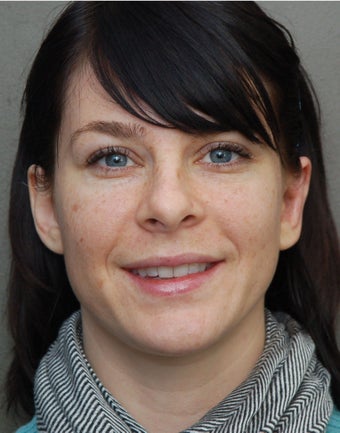 Otoplasty after 273258