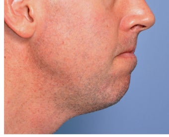Jawline Augmentation 524379