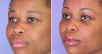 Nose Reshaping before 271205