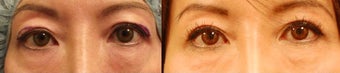 Upper eyelid surgery before 489315
