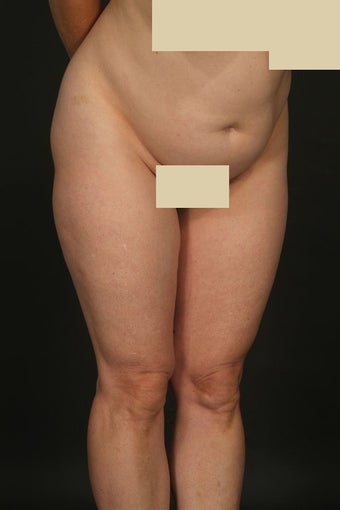 Tummy tuck with hip liposuction before 163112