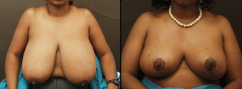 Breast Reduction before 160572