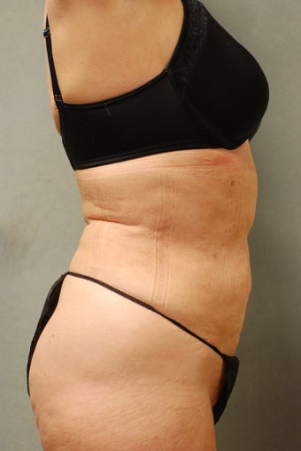 SmartLipo™ 65 Yr Old Female Abs/upper & Lower Flanks, Waist 451399