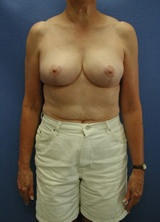 Breast Reduction Surgery (No Implants) after 124962