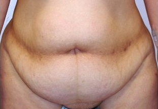 Tummy Tuck (Abdominoplasty) before 142536