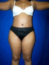 Tummy Tuck (Abdominoplasty) after 428737