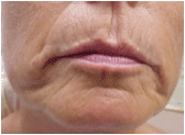 Restylane before 267543