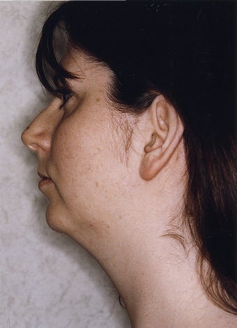 Neck Liposuction 628887