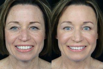 Blue Peel before 311135