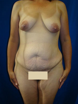 Extended Tummy Tuck, Liposuction, Breast Lift, Breast Augmentation Surgery before 120811