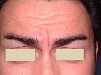 Botox before 93216
