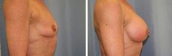 62 years old / Silicone moderate plus profile 400cc's sub muscular before 344002