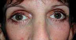 Infraorbital rim implants after 640072