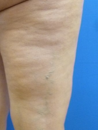 Cellulaze after 571586