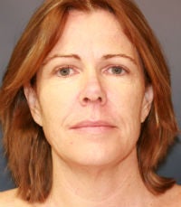 Facelift and laser resurfacing before 285972