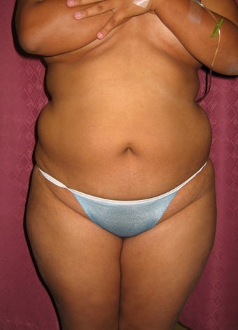 Liposuction of Abdomen and Flanks before 60928