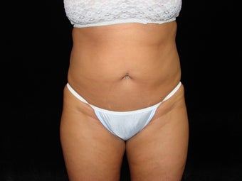 Liposuction of Abdomen, Waist, Flanks, and Inner/Outer Thighs before 203475