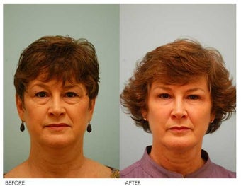 Fat Transfer/Fat Grafting/Facial Rejuvenation before 136355