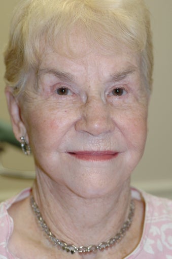 Neck lift, eyelid surgery after 437152