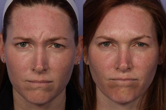 Botox before 321252