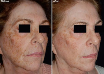 Fraxel Laser Resurfacing before 97772