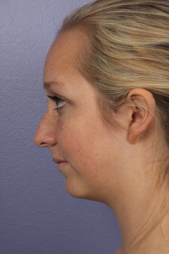Chin Augmentation and Liposuction of the Neck before 611677